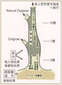 アトピー素因のある人の成人型気管支喘息への移行