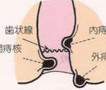 痔核