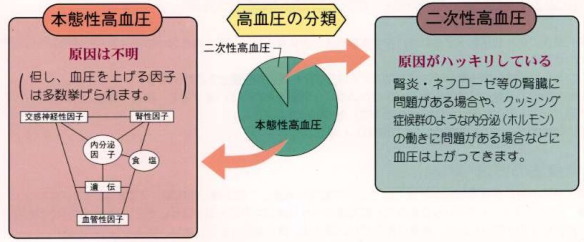 本態性高血圧症と二次性高血圧症の分類と原因