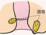肛門周囲潰瘍
