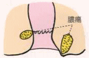 肛門周囲潰瘍