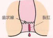 裂肛（切れ痔）